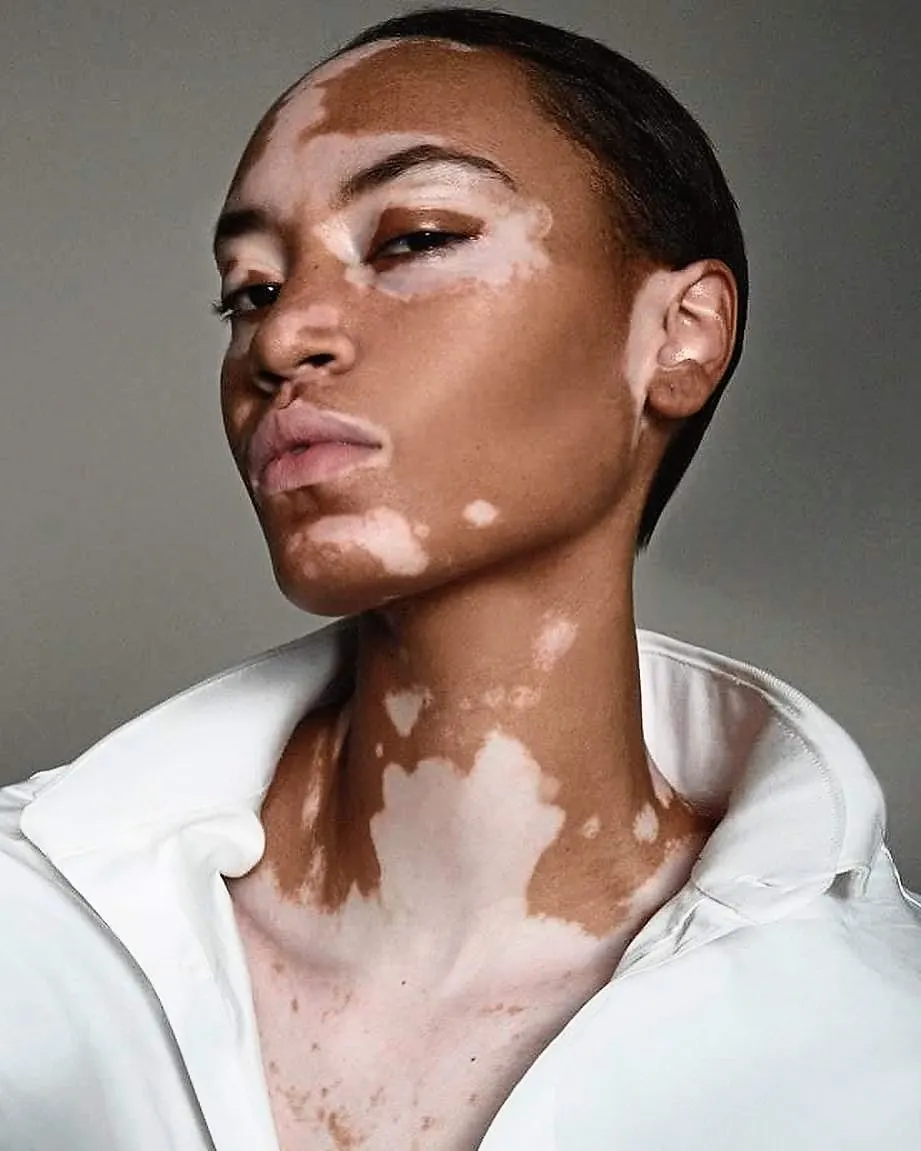 Vitiligo Treatment